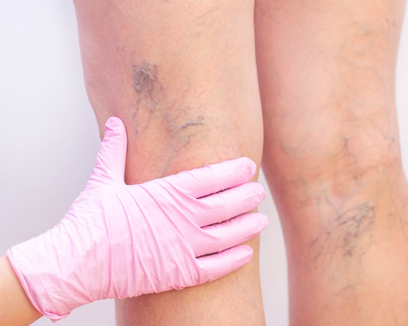 What should people seeking varicose vein treatment for cosmetic reasons pay attention to?
