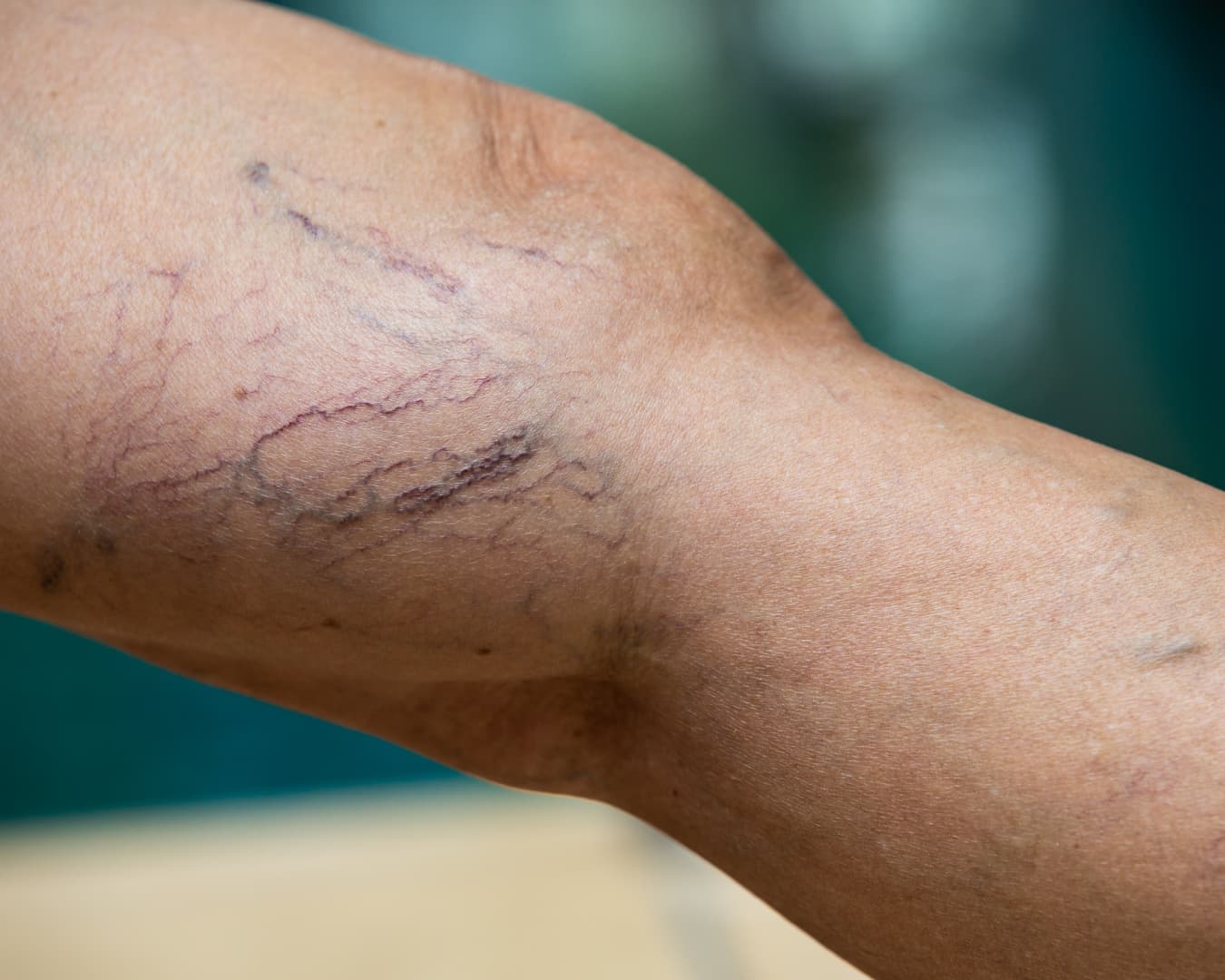 Varisli damarların kapatılması dolaşıma zarar verir mi?