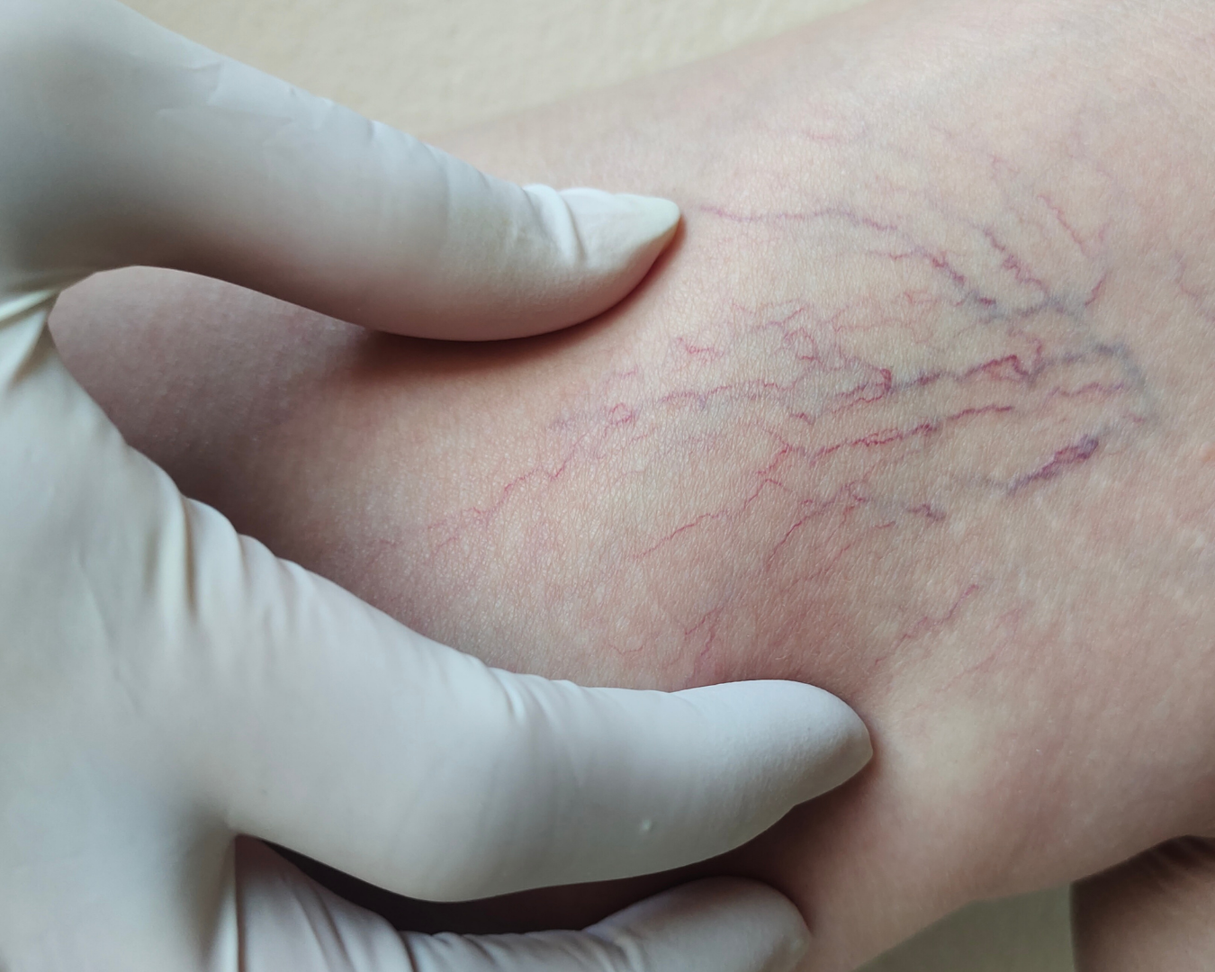 Damar Tıkanıklığı ve Ateroskleroz: Belirtiler, Tanı ve Tedavi Yaklaşımları