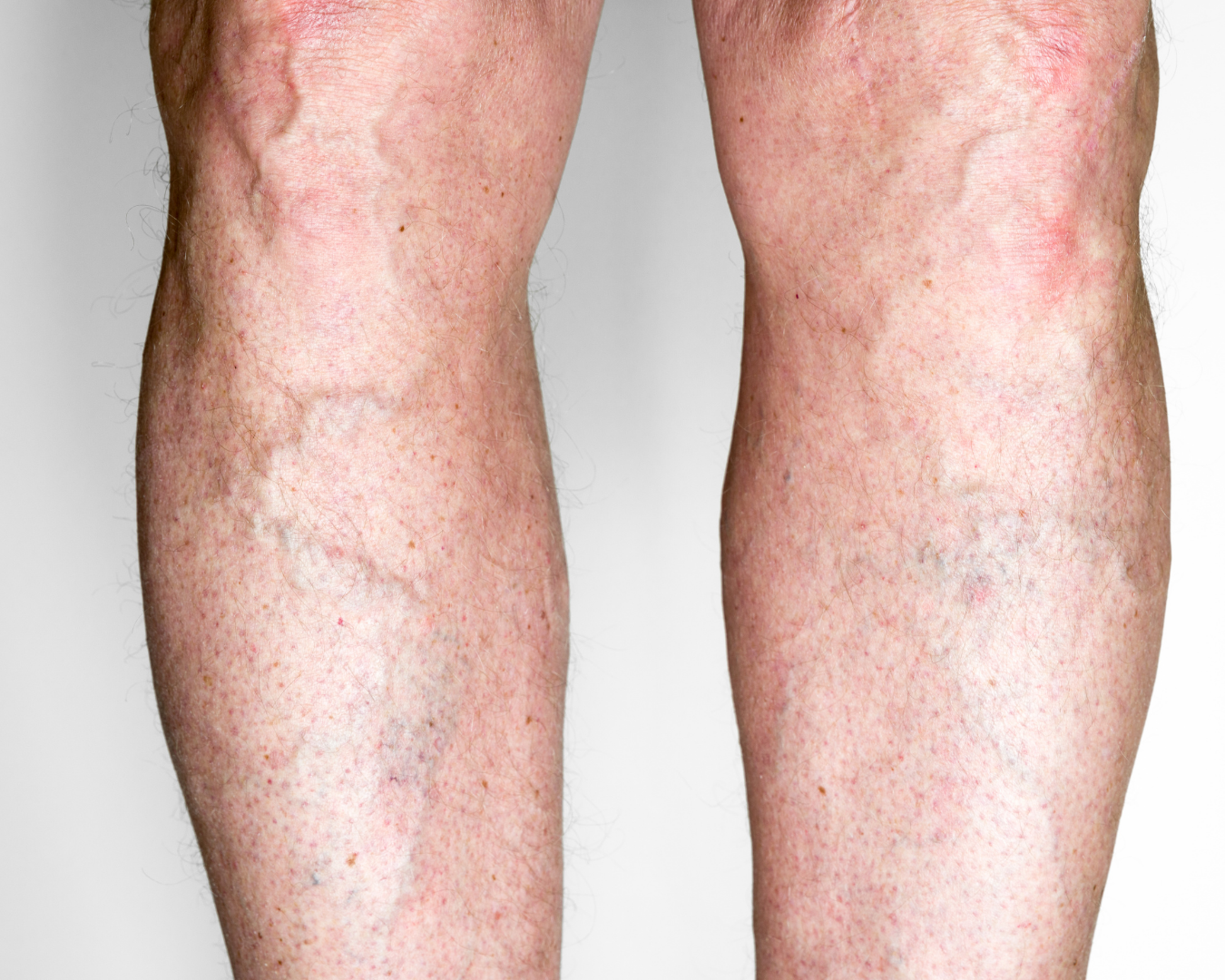 Damar Tıkanıklığı ve Ateroskleroz: Belirtiler, Tanı ve Tedavi Yaklaşımları